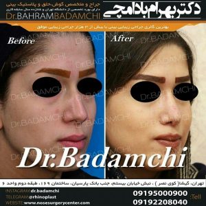 بهترین جراح بینی عروسکی در تهران