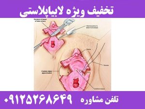 هزینه عمل (جراحی) لابیاپلاستی در شیراز